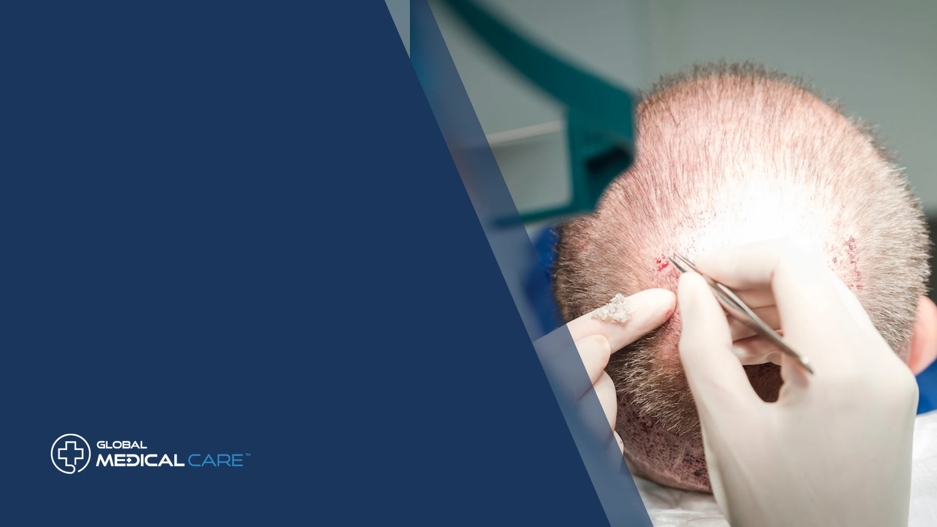 7 Dinge, die Sie vor einer Haartransplantation wissen sollten